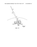 Mechanical tissue modification devices and methods diagram and image