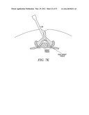 Mechanical tissue modification devices and methods diagram and image