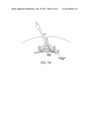 Mechanical tissue modification devices and methods diagram and image