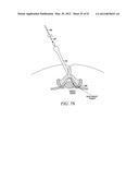 Mechanical tissue modification devices and methods diagram and image