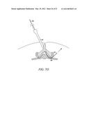 Mechanical tissue modification devices and methods diagram and image