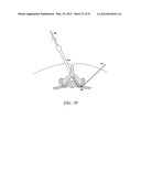 Mechanical tissue modification devices and methods diagram and image