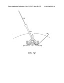 Mechanical tissue modification devices and methods diagram and image