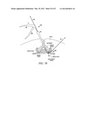 Mechanical tissue modification devices and methods diagram and image