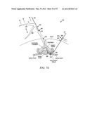 Mechanical tissue modification devices and methods diagram and image