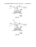 Mechanical tissue modification devices and methods diagram and image