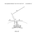 Mechanical tissue modification devices and methods diagram and image