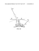 Mechanical tissue modification devices and methods diagram and image