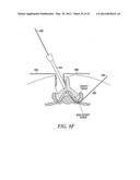 Mechanical tissue modification devices and methods diagram and image