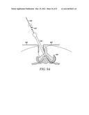 Mechanical tissue modification devices and methods diagram and image