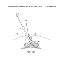 Mechanical tissue modification devices and methods diagram and image