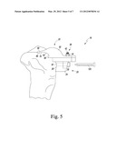 CUSTOMIZED PATIENT-SPECIFIC COMPUTER CONTROLLED CUTTING SYSTEM AND METHOD diagram and image