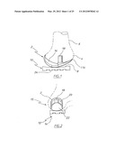 METHOD OF ARTHROPLASTY ON A KNEE JOINT AND APPARATUS FOR USE IN SAME diagram and image