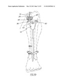 METHOD OF ARTHROPLASTY ON A KNEE JOINT AND APPARATUS FOR USE IN SAME diagram and image