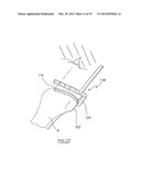 METHOD OF ARTHROPLASTY ON A KNEE JOINT AND APPARATUS FOR USE IN SAME diagram and image