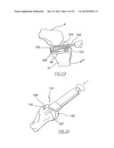 METHOD OF ARTHROPLASTY ON A KNEE JOINT AND APPARATUS FOR USE IN SAME diagram and image