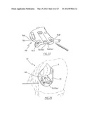 METHOD OF ARTHROPLASTY ON A KNEE JOINT AND APPARATUS FOR USE IN SAME diagram and image