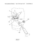 METHOD OF ARTHROPLASTY ON A KNEE JOINT AND APPARATUS FOR USE IN SAME diagram and image