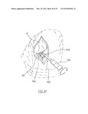 METHOD OF ARTHROPLASTY ON A KNEE JOINT AND APPARATUS FOR USE IN SAME diagram and image