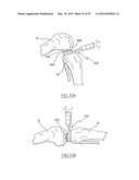 METHOD OF ARTHROPLASTY ON A KNEE JOINT AND APPARATUS FOR USE IN SAME diagram and image