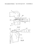 METHOD OF ARTHROPLASTY ON A KNEE JOINT AND APPARATUS FOR USE IN SAME diagram and image