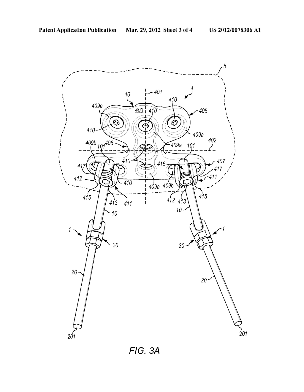 BONE FIXATION SYSTEMS AND METHODS - diagram, schematic, and image 04