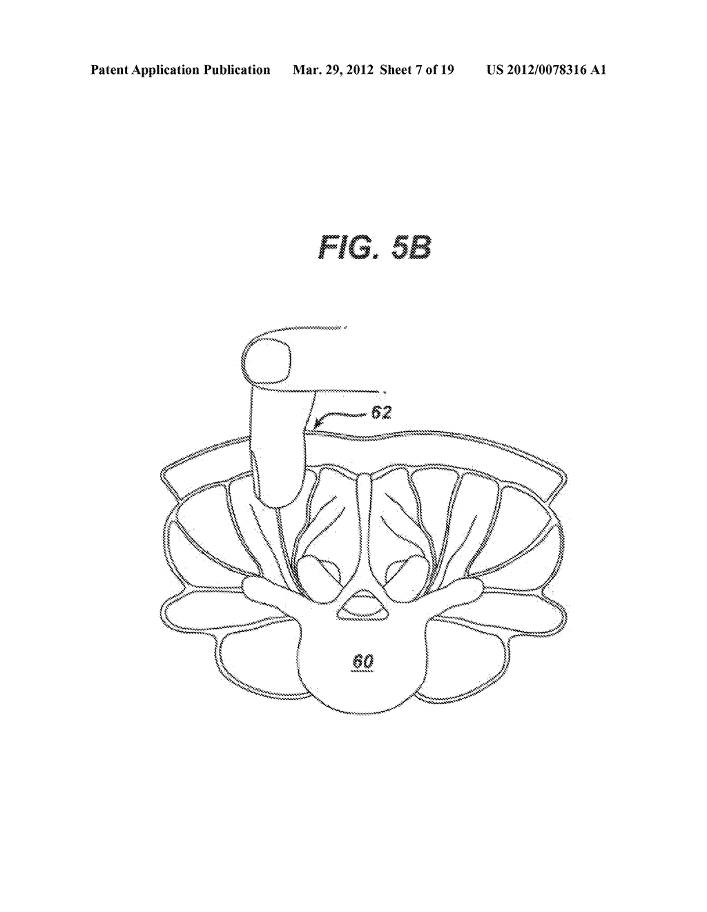 Methods and Devices for Minimally Invasive Spinal Fixation Element     Placement - diagram, schematic, and image 08