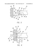 METHOD FOR INDICATING EMBEDMENT OF A HELICAL ANCHOR IN CARDIAC TISSUE VIA     FLUOROSCOPY diagram and image