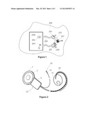 REFERENCE ELECTRODES FOR INNER EAR STIMULATION DEVICES diagram and image