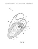 REPLACEMENT HEART VALVES, DELIVERY DEVICES AND METHODS diagram and image