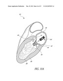 REPLACEMENT HEART VALVES, DELIVERY DEVICES AND METHODS diagram and image