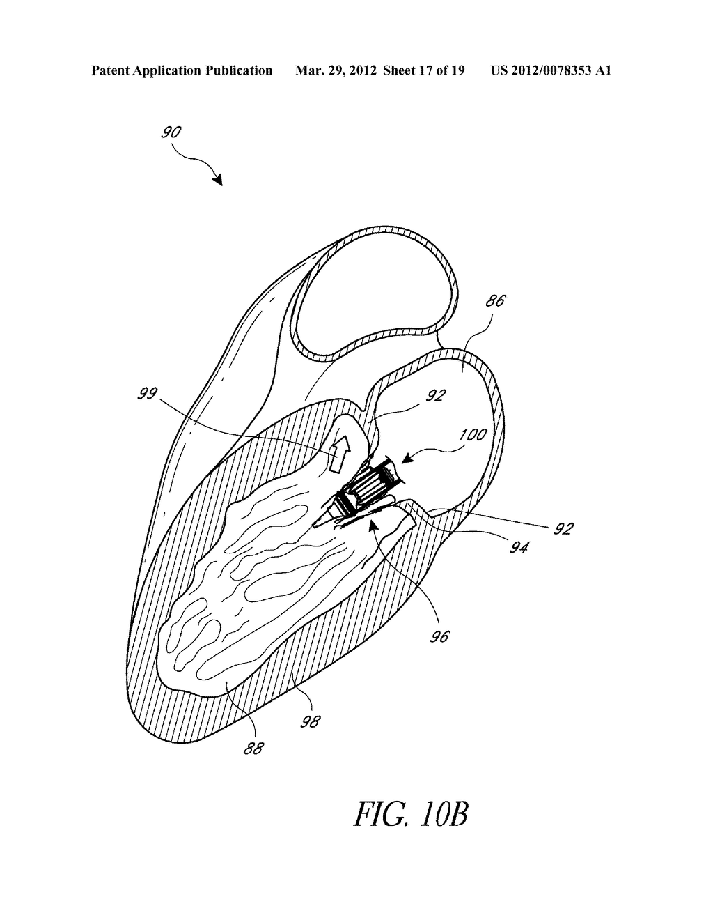 REPLACEMENT HEART VALVES, DELIVERY DEVICES AND METHODS - diagram, schematic, and image 18