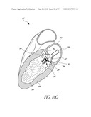 REPLACEMENT HEART VALVES, DELIVERY DEVICES AND METHODS diagram and image