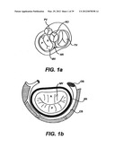 Devices and Methods for Heart Valve Treatment diagram and image