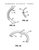 Devices and Methods for Heart Valve Treatment diagram and image