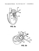 Devices and Methods for Heart Valve Treatment diagram and image