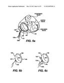 Devices and Methods for Heart Valve Treatment diagram and image