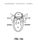 Devices and Methods for Heart Valve Treatment diagram and image