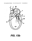 Devices and Methods for Heart Valve Treatment diagram and image