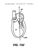 Devices and Methods for Heart Valve Treatment diagram and image