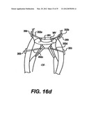 Devices and Methods for Heart Valve Treatment diagram and image