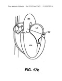 Devices and Methods for Heart Valve Treatment diagram and image