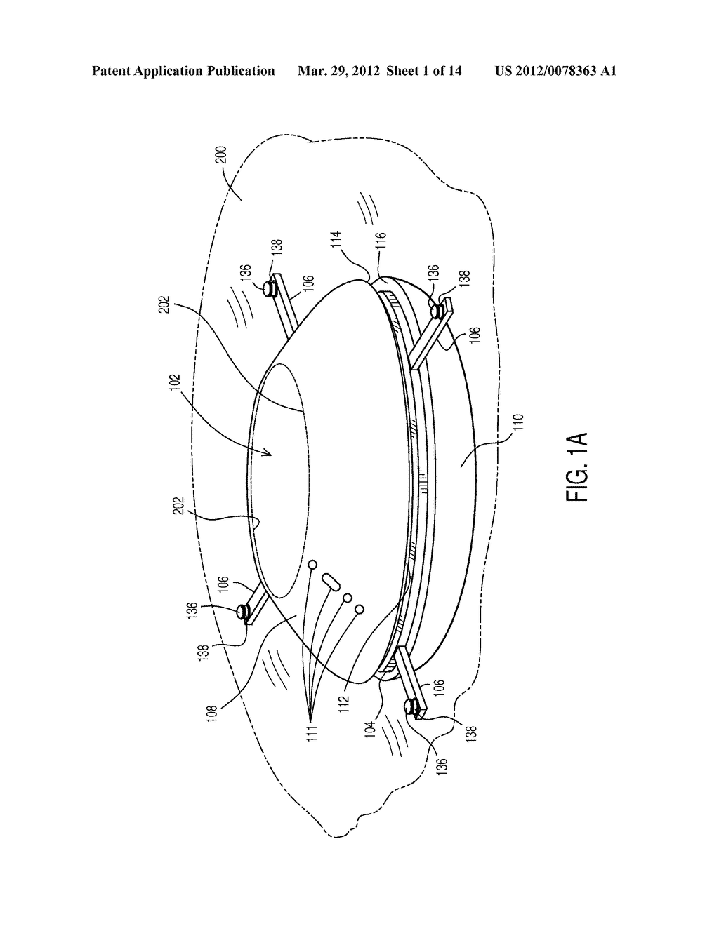 ACCOMMODATING INTRAOCULAR LENS - diagram, schematic, and image 02