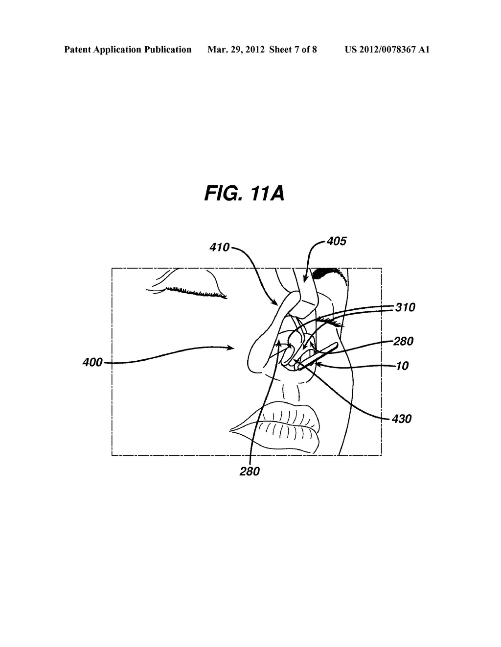 COLUMELLAR STRUT FOR NASAL TIP SUPPORT - diagram, schematic, and image 08