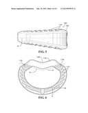 SPINAL IMPLANTS diagram and image