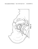 SPINAL IMPLANTS diagram and image