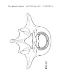 SPINAL IMPLANTS diagram and image