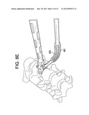 NOVEL IMPLANT INSERTER HAVING A LATERALLY-EXTENDING DOVETAIL ENGAGEMENT     FEATURE diagram and image