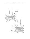 MEASUREMENT SYSTEM FOR VARUS/VALGUS ANGLES IN FEET diagram and image