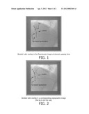 DEVICE SIZING SUPPORT DURING INTERVENTIONS diagram and image